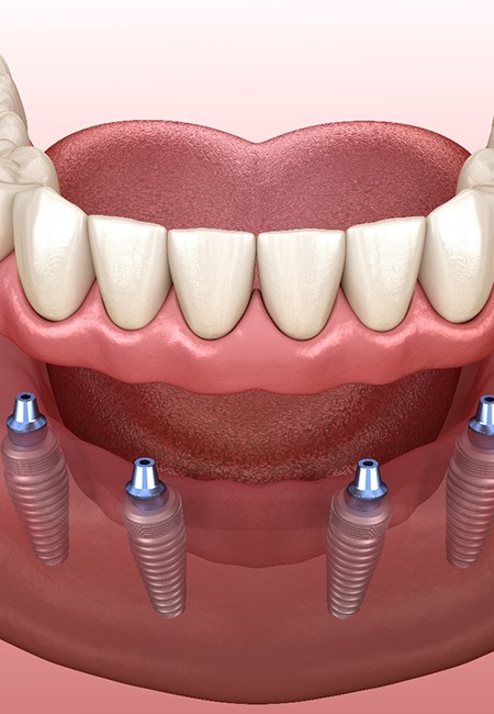  3D render of an implant denture