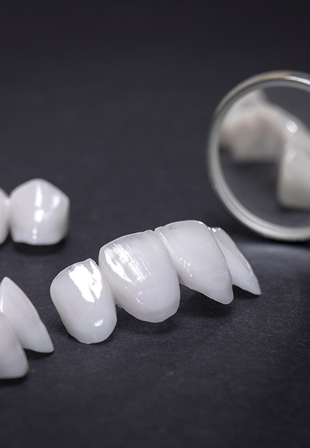 An example of veneers in Lutz from Allure Dental Boutique