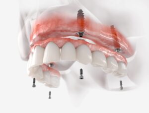 Red, white, and gray rendering of dentures anchored by dental implants